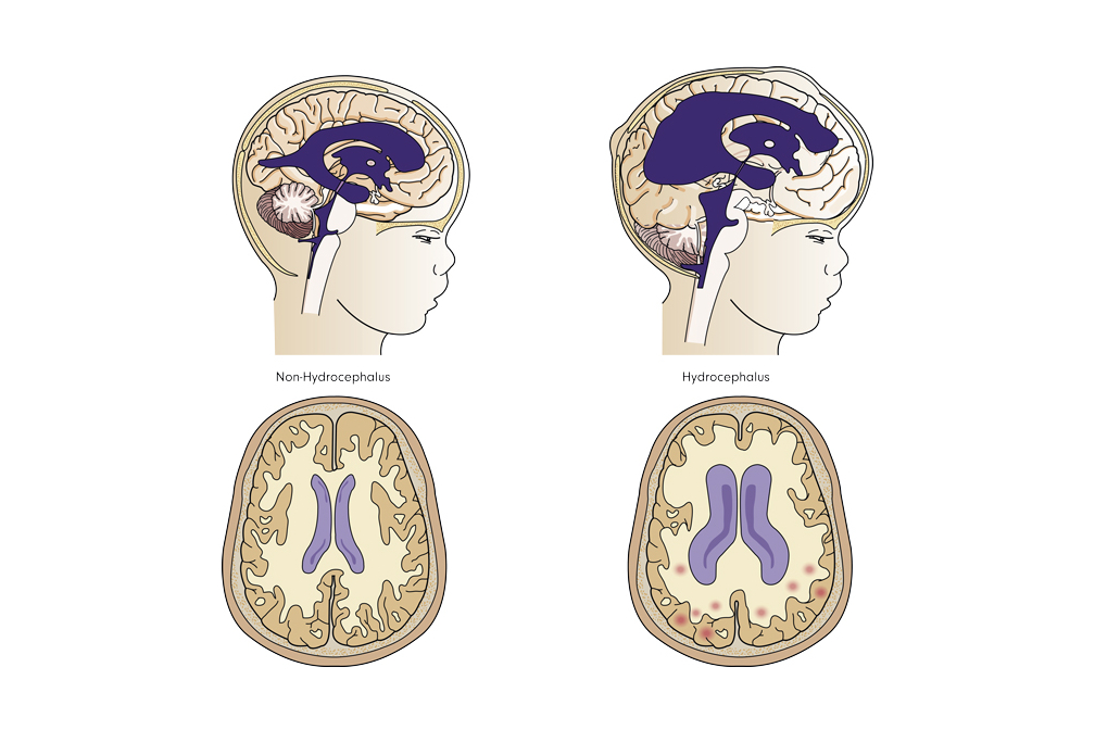 صورة توضيحية لاستسقاء الدماغي