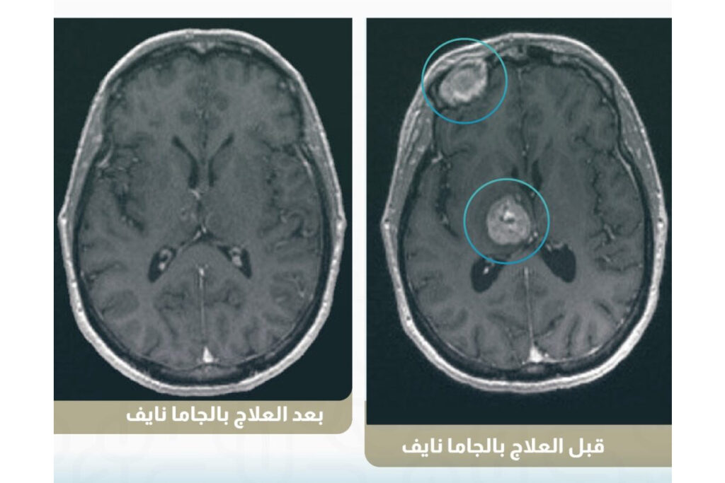 صورة اشعة تظهر الاورام الدماغية الانتقالية