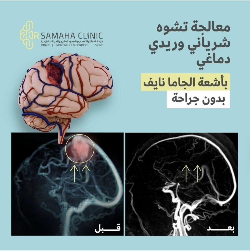 التشوه الشرياني الوريدي قبل وبعد
