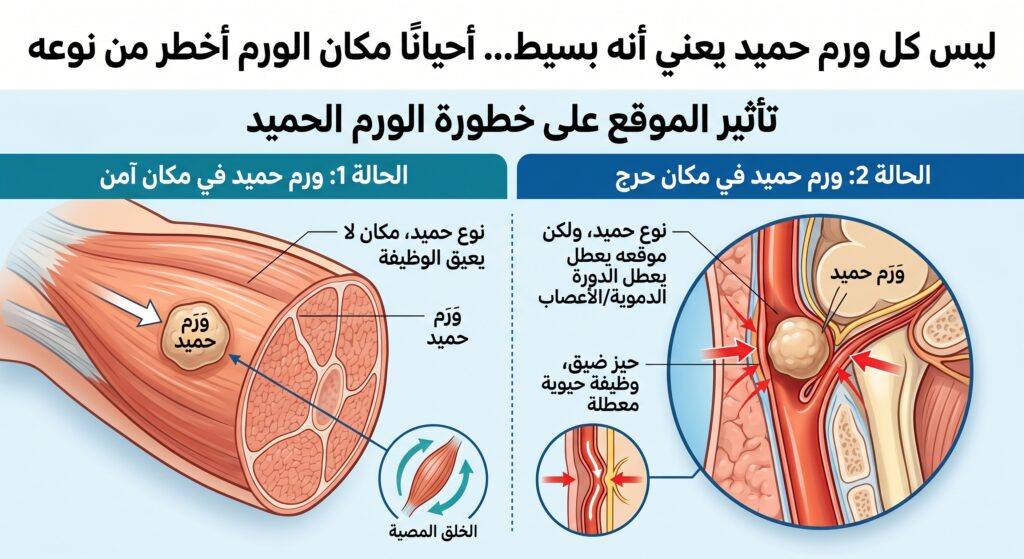 ليس كل ورم حميد يعني أنه بسيط… أحيانًا مكان الورم أخطر من نوعه