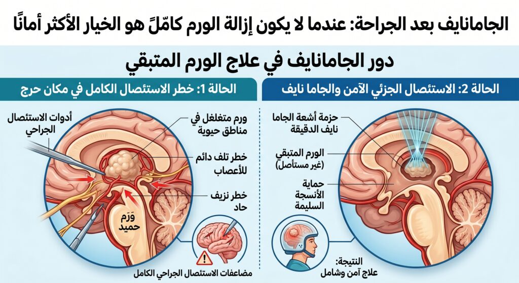 الجاما نايف بعد الجراحة: عندما لا يكون إزالة الورم كامًلً هو الخيار الأكثر أمانًا